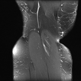 File:Acute-on-chronic transient lateral patellar dislocation with trochlear dysplasia (Radiopaedia 84099-99349 Coronal PD fat sat 2).jpg