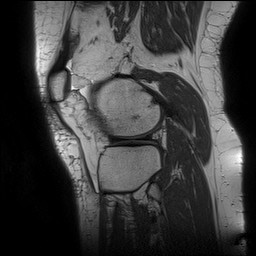 File:Acute-on-chronic transient lateral patellar dislocation with trochlear dysplasia (Radiopaedia 84099-99349 Sagittal PD 123).jpg