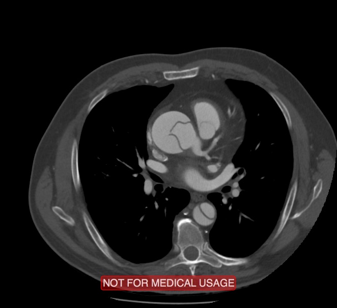 Acute aortic dissection - Stanford type A (Radiopaedia 40661-43285 Axial C+ arterial phase 32).jpg