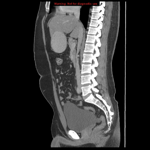 File:Acute appendicitis (Radiopaedia 10498-10973 Sagittal C+ portal venous phase 28).jpg