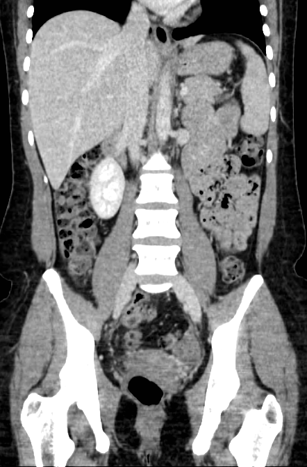Acute appendicitis (Radiopaedia 22892-22918 Coronal C+ portal venous phase 30).png