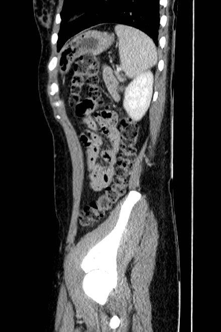 Acute appendicitis (Radiopaedia 22892-22918 Sagittal C+ portal venous phase 71).png