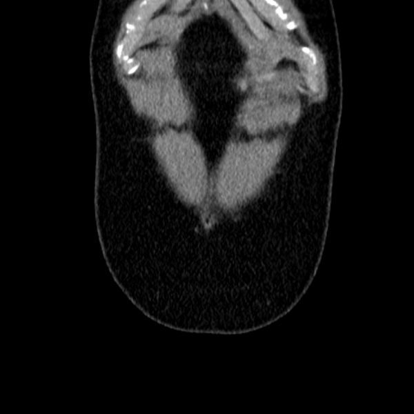Acute appendicitis (Radiopaedia 38255-40270 Coronal C+ portal venous phase 12).jpg