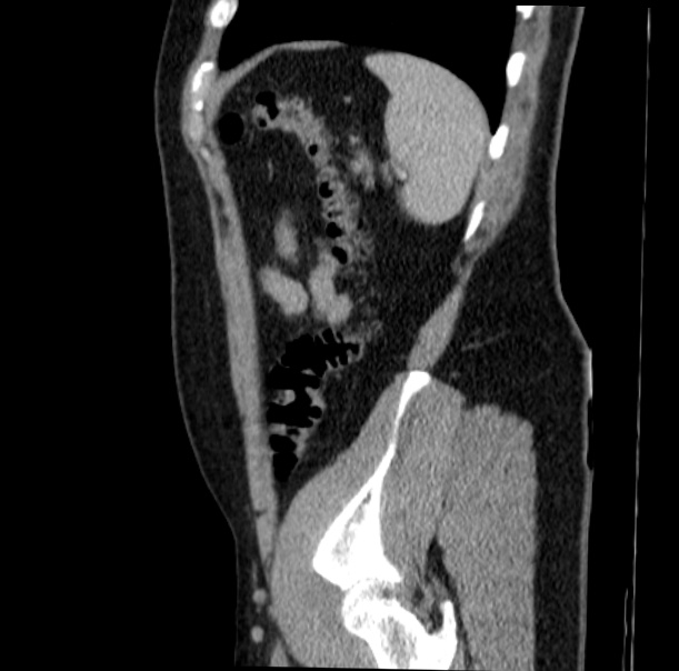 Acute appendicitis (Radiopaedia 38255-40270 Sagittal C+ portal venous phase 68).jpg