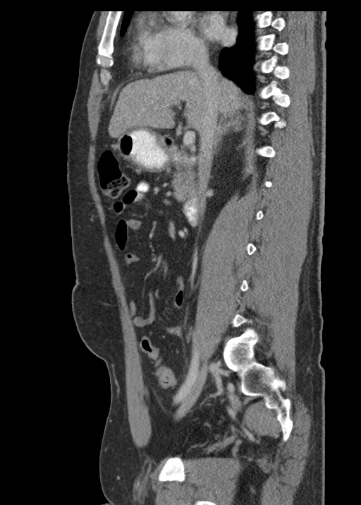 Acute appendicitis (Radiopaedia 48511-53463 Sagittal C+ portal venous phase 62).jpg