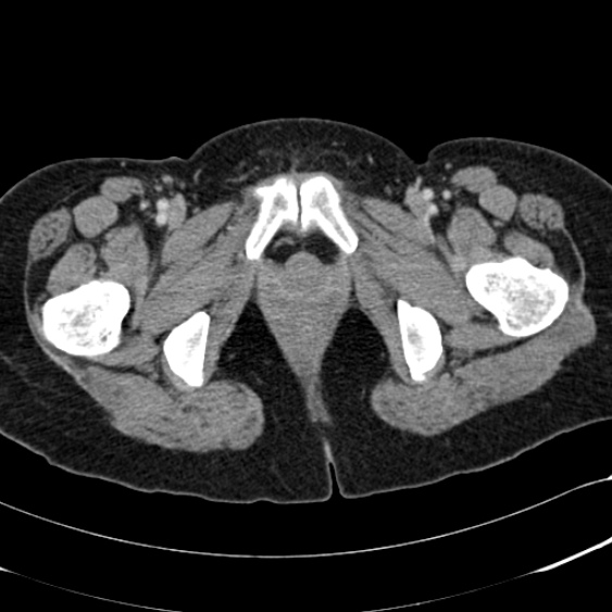 Acute appendicitis (Radiopaedia 48792-53822 Axial C+ portal venous phase 123).jpg