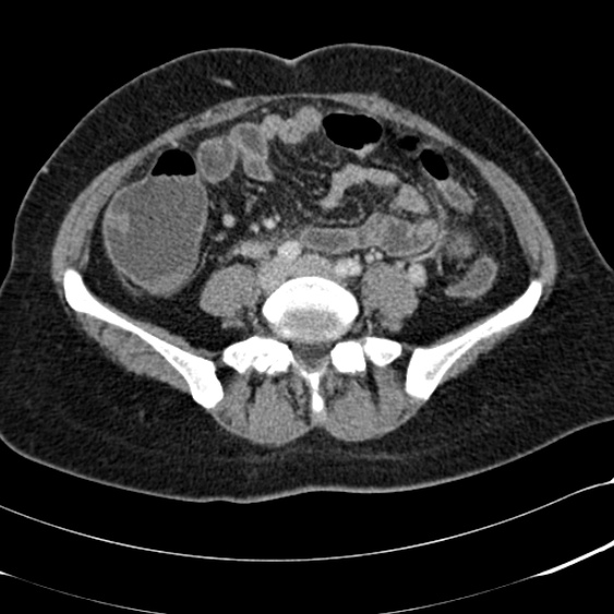 Acute appendicitis (Radiopaedia 48792-53822 Axial C+ portal venous phase 74).jpg
