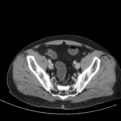 Acute appendicitis (Radiopaedia 66513-75790 Axial C+ portal venous phase 75).jpg