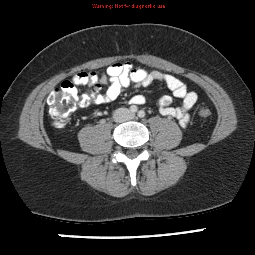File:Acute appendicitis (Radiopaedia 7966-8812 C+ portal venous phase 29).jpg