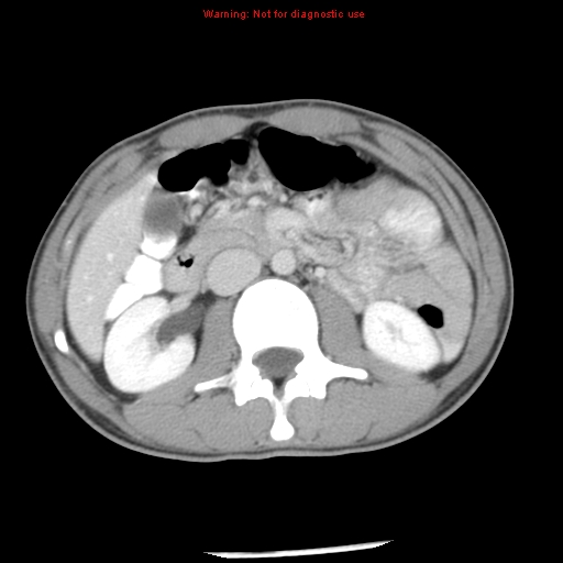 Acute appendicitis (Radiopaedia 8195-9045 Axial C+ portal venous phase 31).jpg