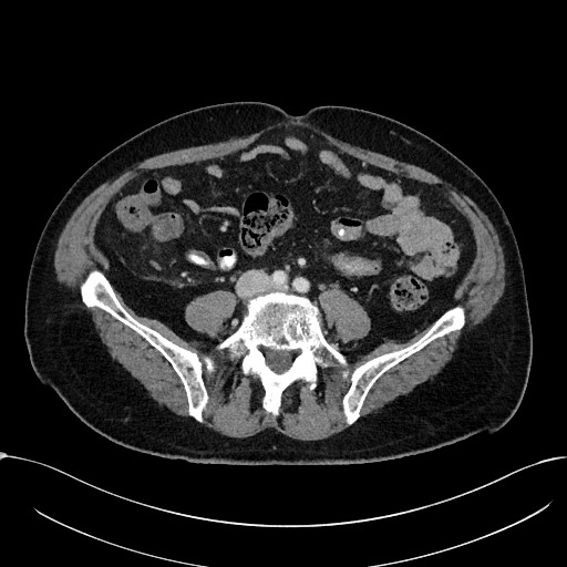 Acute appendicitis - large appendicoliths (Radiopaedia 61805-69820 Axial C+ portal venous phase 82).jpg