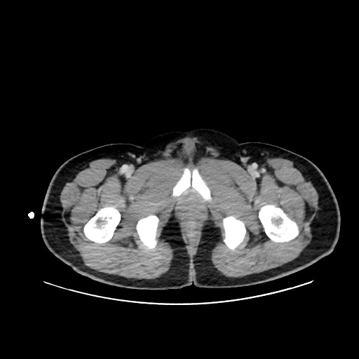 Acute appendicitis and COVID 19 pneumonia (Radiopaedia 76604-88380 Axial C+ portal venous phase 89).jpg
