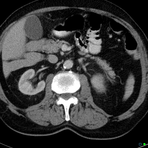 File:Acute appendicitis arising from a malrotated cecum (Radiopaedia 19970-19997 Axial C+ portal venous phase 8).jpg