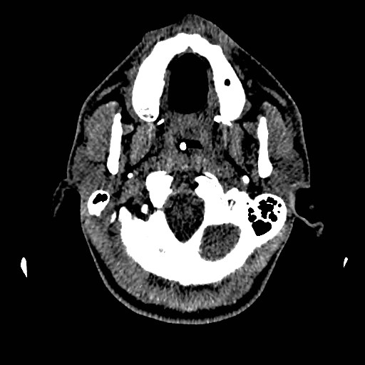 File:Acute basilar artery occlusion (Radiopaedia 43582-46985 Axial non-contrast 27).jpg