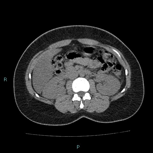 Acute bilateral pyelonephritis (Radiopaedia 37146-38881 Axial non-contrast 47).jpg