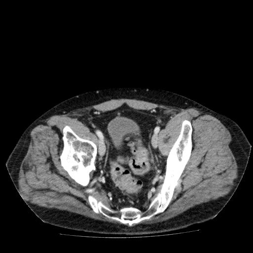Acute cholecystitis and incidental left sided IVC (Radiopaedia 49352-54459 Axial C+ portal venous phase 133).jpg