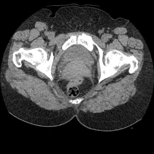 File:Acute cholecystitis and ureteric colic (Radiopaedia 42330-45444 Axial prone 108).jpg