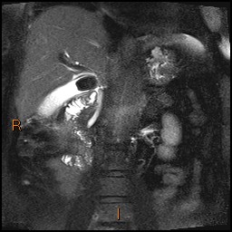 File:Acute cholecystitis with gallbladder neck calculus (Radiopaedia 42795-45971 Coronal T2 Half-fourier-acquired single-shot turbo spin echo (HASTE) 2).jpg