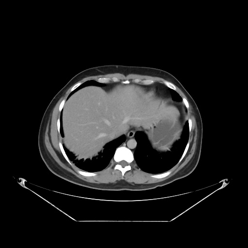 File:Acute complicated calculous cholecystitis (Radiopaedia 55202-61587 Axial C+ delayed 21).jpg