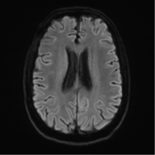 File:Acute disseminated encephalomyelitis (ADEM) (Radiopaedia 65319-74350 Axial DWI 20).png
