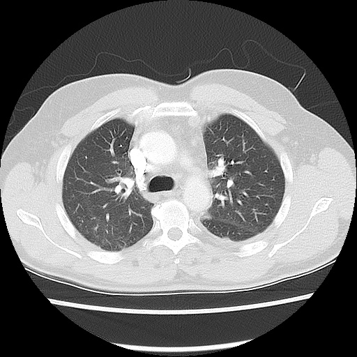 Acute epicardial fat necrosis (Radiopaedia 42327-45440 Axial lung window 23).jpg