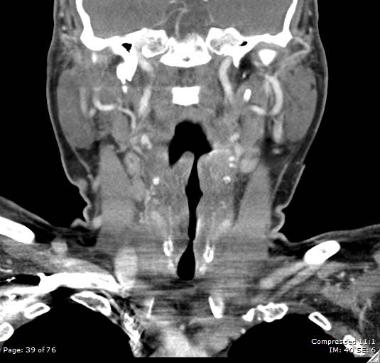 File:Acute epiglottitis (Radiopaedia 54375-60590 Coronal C+ arterial phase 39).jpg