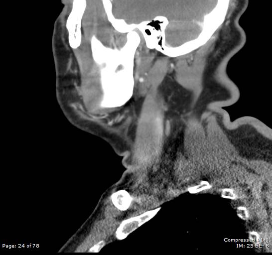 Acute epiglottitis (Radiopaedia 54375-60590 Sagittal C+ arterial phase 24).jpg