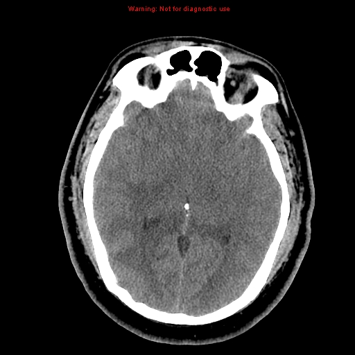 Acute hemorrhagic leukoencephalitis (Radiopaedia 14076-13920 Axial non-contrast 22).jpg
