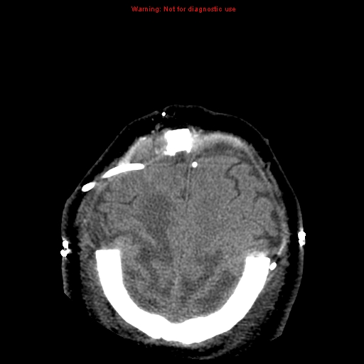 Acute hemorrhagic leukoencephalitis (Radiopaedia 14076-43697 Axial non-contrast 43).jpg