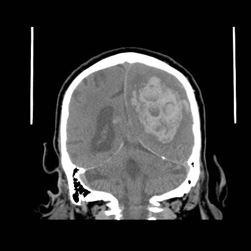 Acute hemorrhagic stroke (Radiopaedia 17507-17223 Coronal non-contrast 37).jpg
