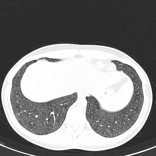 File:Acute hypersensitivity pneumonitis (Radiopaedia 85293-100870 Axial lung window 101).jpg