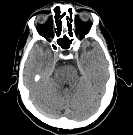 File:Acute internal carotid artery dissection (Radiopaedia 53541-59558 Axial non-contrast 19).jpg