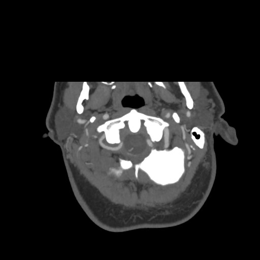 File:Acute internal carotid artery dissection (Radiopaedia 53541-59630 D 4).jpg