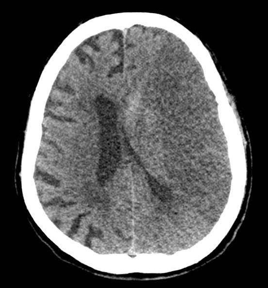 File:Acute left ICA and M1 occlusion treated with mechanical thrombectomy (Radiopaedia 56085-62815 Axial non-contrast 1).jpg
