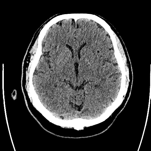 File:Acute left middle cerebral artery territory ischemic stroke (Radiopaedia 35688-37223 Axial non-contrast 35).png