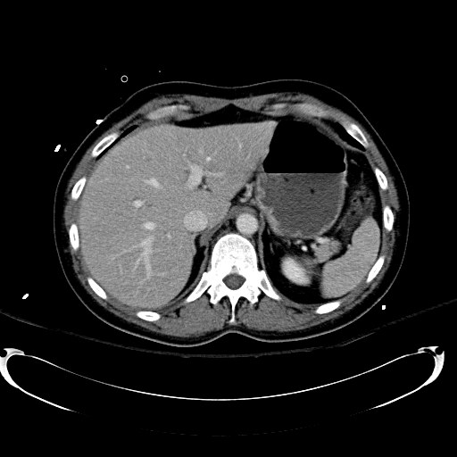 Acute myocardial infarction in CT (Radiopaedia 39947-42415 Axial C+ portal venous phase 29).jpg