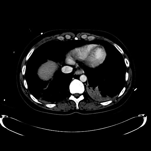 File:Acute myocardial infarction in CT (Radiopaedia 39947-42457 Axial C+ portal venous phase 13).jpg