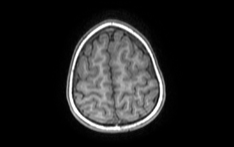 Acute necrotizing encephalitis of childhood (Radiopaedia 67356-76737 Axial T1 13).jpg