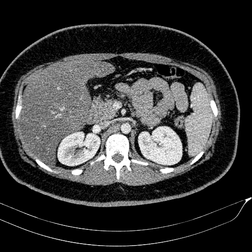 Acute on chronic pancreatitis (Radiopaedia 80902-94423 Axial C+ portal venous phase 61).jpg