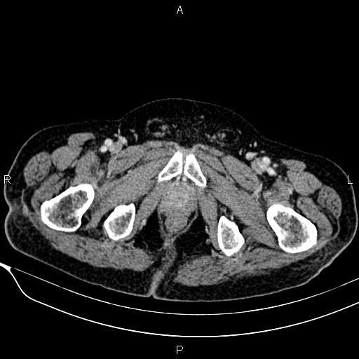 Acute pancreatitis (Radiopaedia 85146-100701 Axial C+ portal venous phase 65).jpg