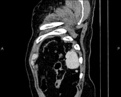 Acute pancreatitis (Radiopaedia 85146-100701 Sagittal C+ portal venous phase 90).jpg