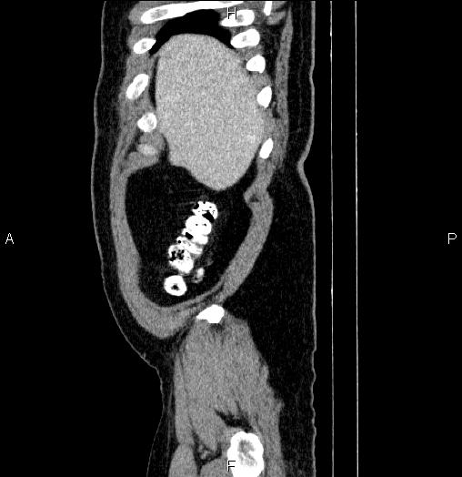 Acute pancreatitis (Radiopaedia 85390-101010 Sagittal C+ portal venous phase 5).jpg