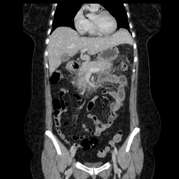 Acute pancreatitis - Balthazar C (Radiopaedia 26569-26714 Coronal C+ portal venous phase 28).jpg