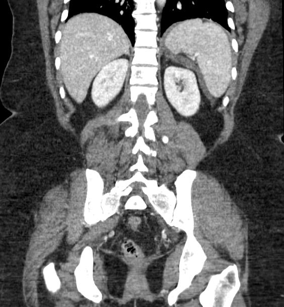 Acute pancreatitis - Balthazar E (Radiopaedia 29016-29377 Coronal C+ portal venous phase 67).png