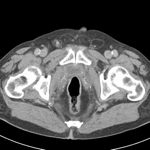 File:Acute pancreatitis and walled-off necrosis (Radiopaedia 29888-30403 Axial C+ delayed 82).jpg