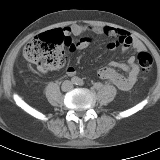 File:Acute pancreatitis and walled-off necrosis (Radiopaedia 29888-30403 Axial non-contrast 47).jpg