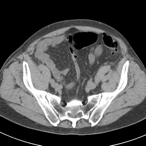 File:Acute pancreatitis and walled-off necrosis (Radiopaedia 29888-30403 Axial non-contrast 60).jpg