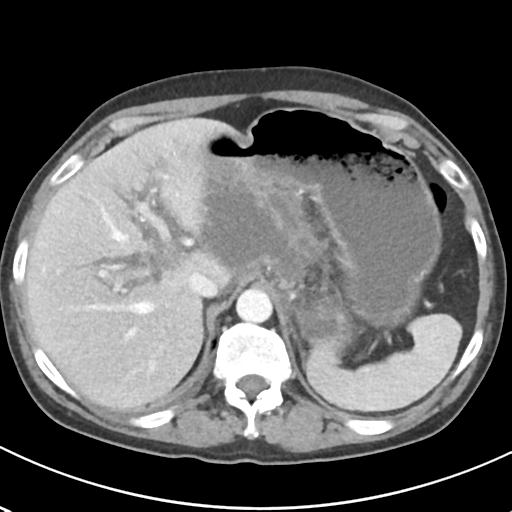 File:Acute pancreatitis and walled-off necrosis (Radiopaedia 29888-30404 Axial C+ portal venous phase 18).jpg