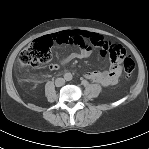 File:Acute pancreatitis and walled-off necrosis (Radiopaedia 29888-30404 Axial non-contrast 48).jpg