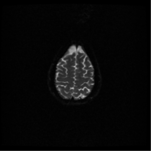 File:Acute pontine infarct from vertebral artery dissection (Radiopaedia 34111-35370 Axial DWI 44).png